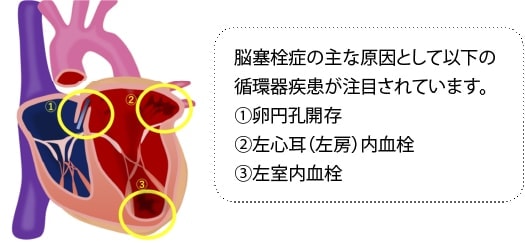 脳塞栓症の主な原因として以下の循環器疾患が注目されています。①卵円孔開存②左心耳（左房）内血栓③左室内血栓